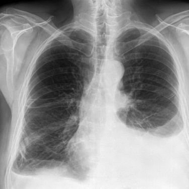pleural-effusion