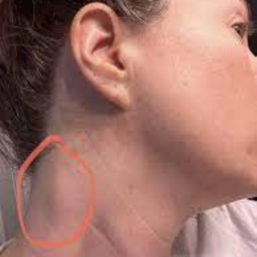 interstitial-lung-disease